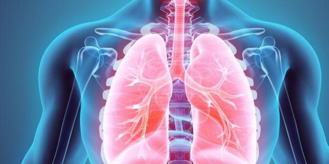 Qué es un edema pulmonar Y cuáles son sus síntomas