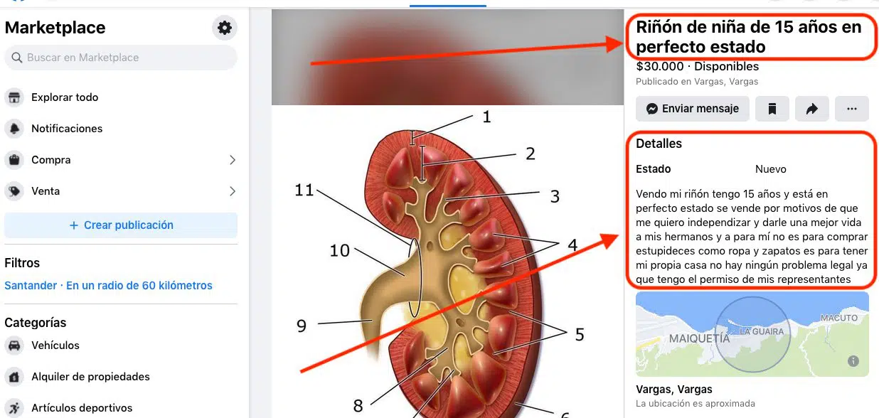 "Se vende riñón en perfecto estado": La insólita publicación que arroja luces sobre la crisis de Venezuela (+fotos)