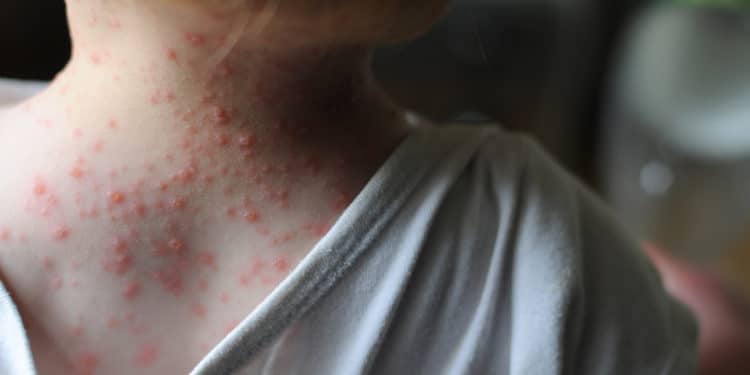 A two year old boy with chicken pox. Day 2.