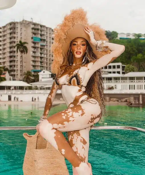 Winnie Harlow